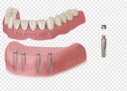 dental implants coogee