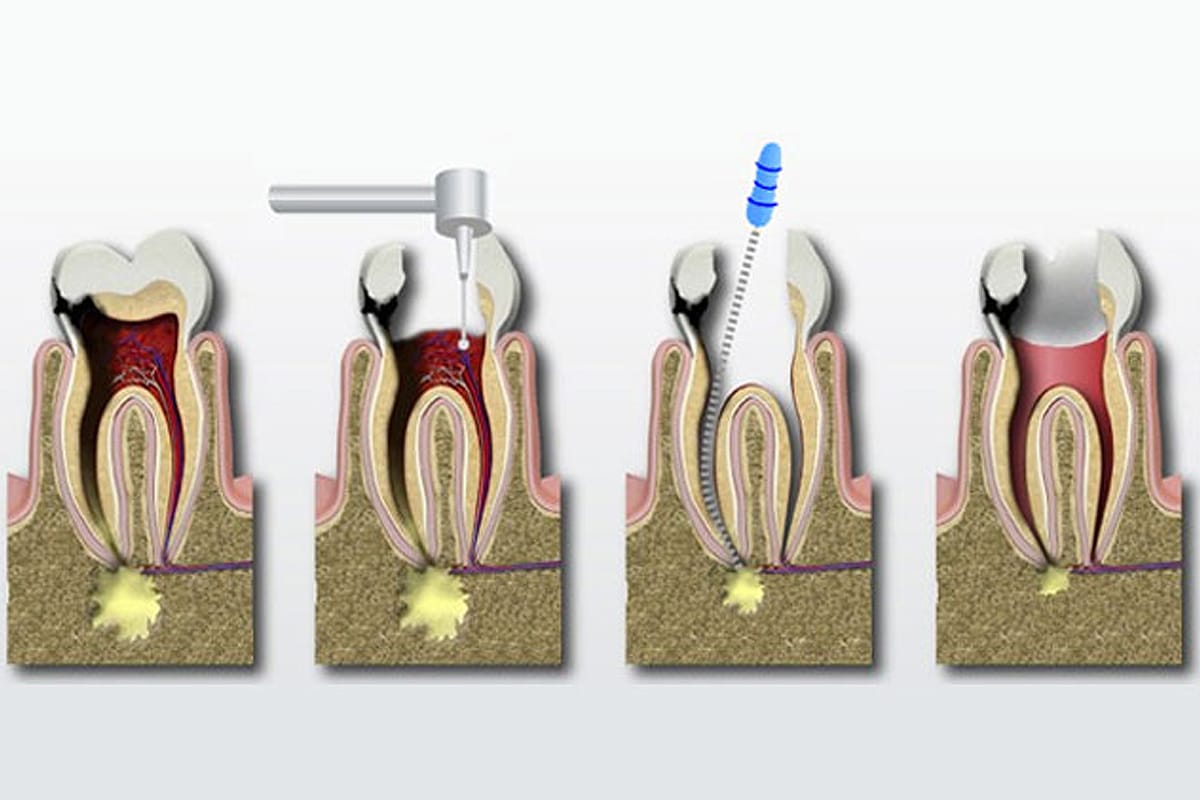 dentures casula