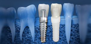 Dental-Implants-Strathfield
