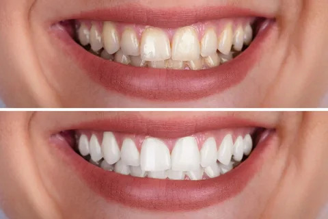 teeth whitening near me
