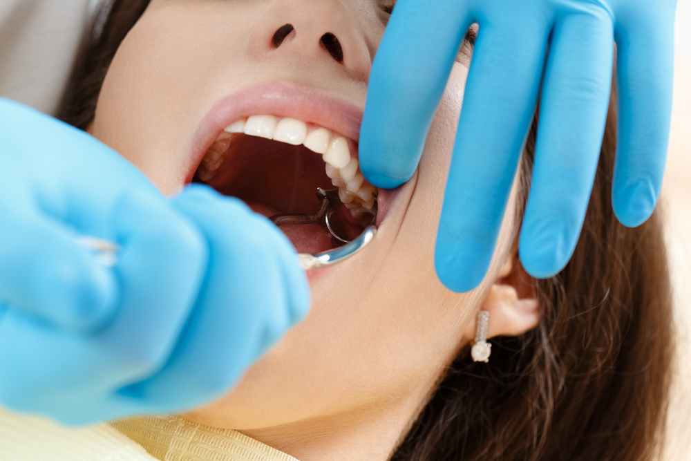 wisdom teeth extraction Cronulla