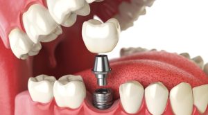 dental implants