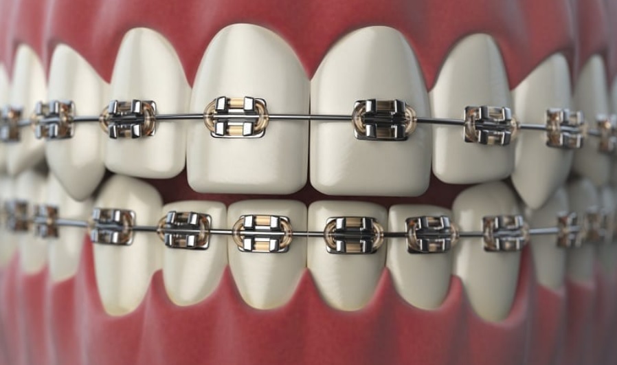Affordable Braces Sydney