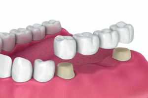 crown and bridge treatments