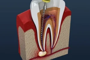 root canal treatment Parramatta