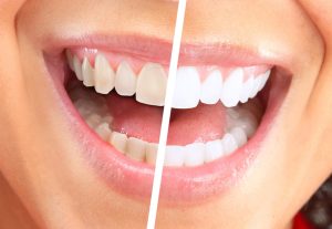teeth whitening barangaroo