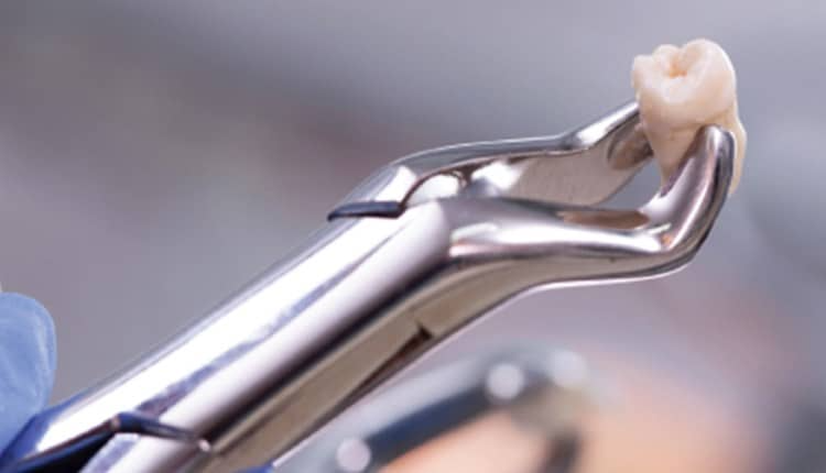 A Complete Guide to Wisdom Teeth Removal in Mill Park
